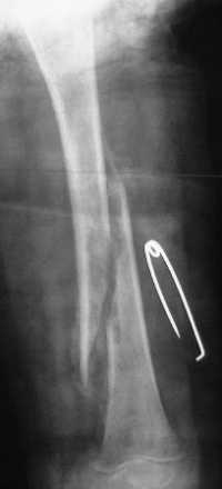 Fracture spiroïde du jeune enfant	